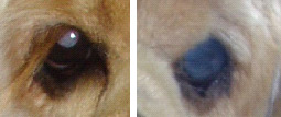 図10 右眼：白内障、左眼：シリコン挿入術